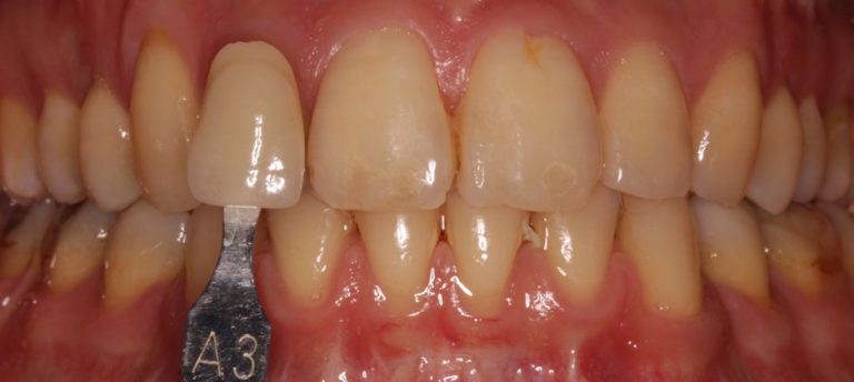 dentista grosseto sbiancamento dentale
