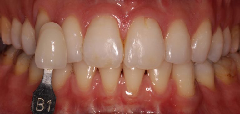 dentista grosseto sbiancamento dentale